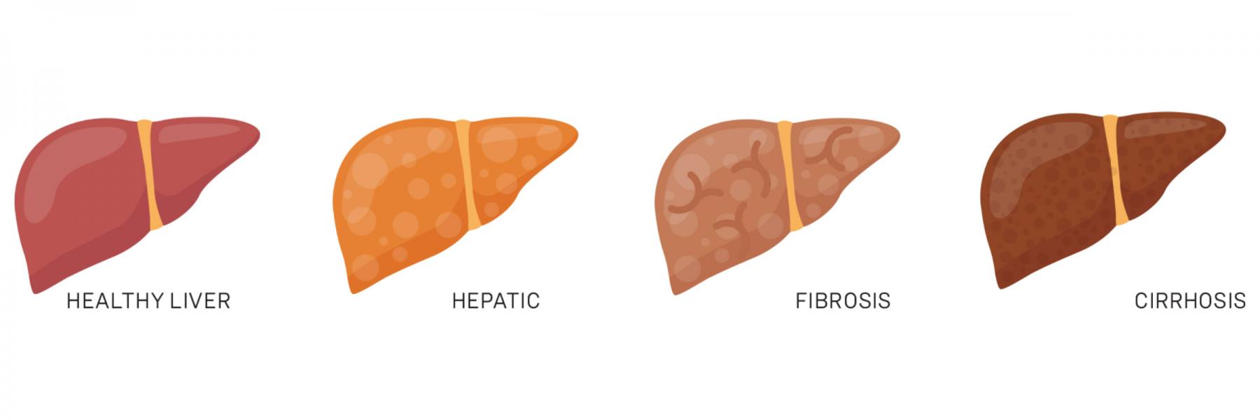 Your Liver And Hepatitis | Positively Aware