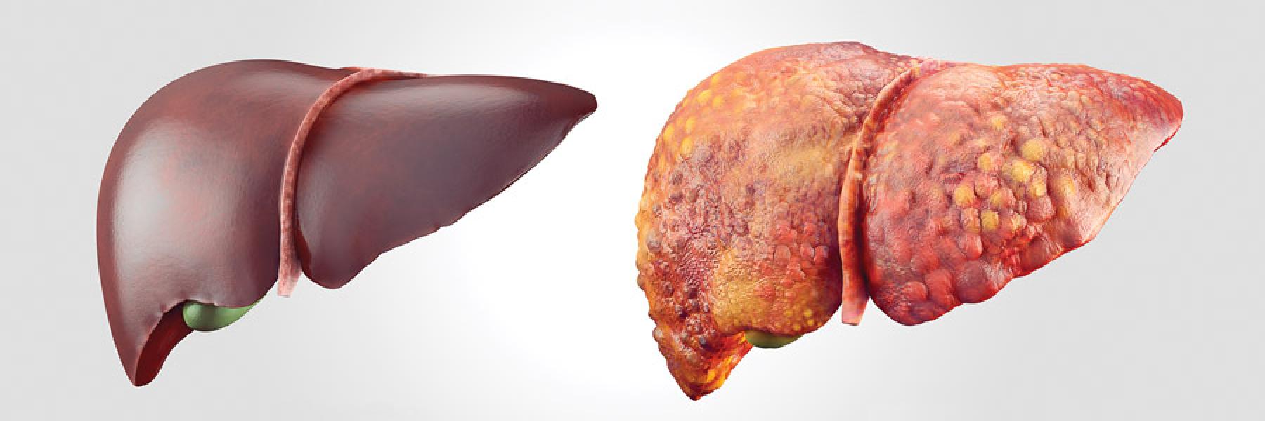 Your Liver And Hepatitis—a Primer | Positively Aware